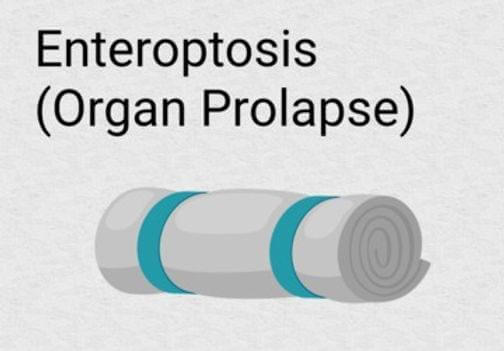 Yoga for Enteroptosis, Yoga therapy for prolapse of the abdominal organs